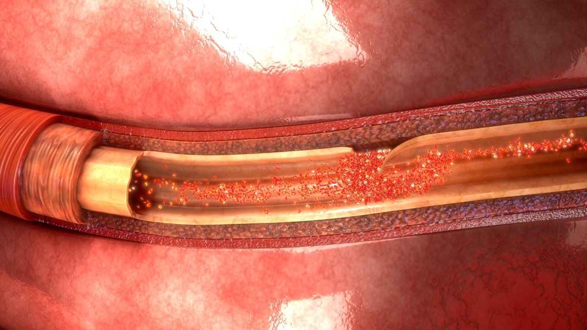 Artery Dissection 3d illustration