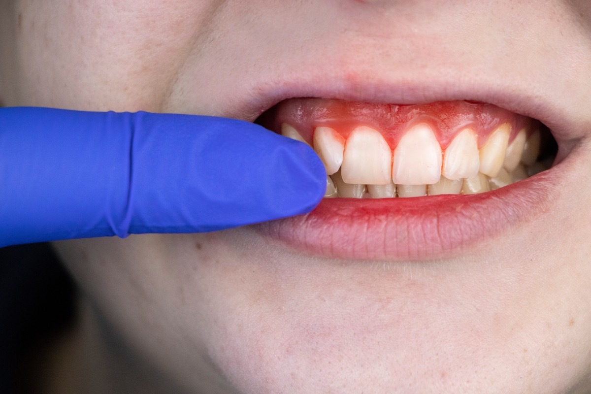 Mouth with Swollen Gums