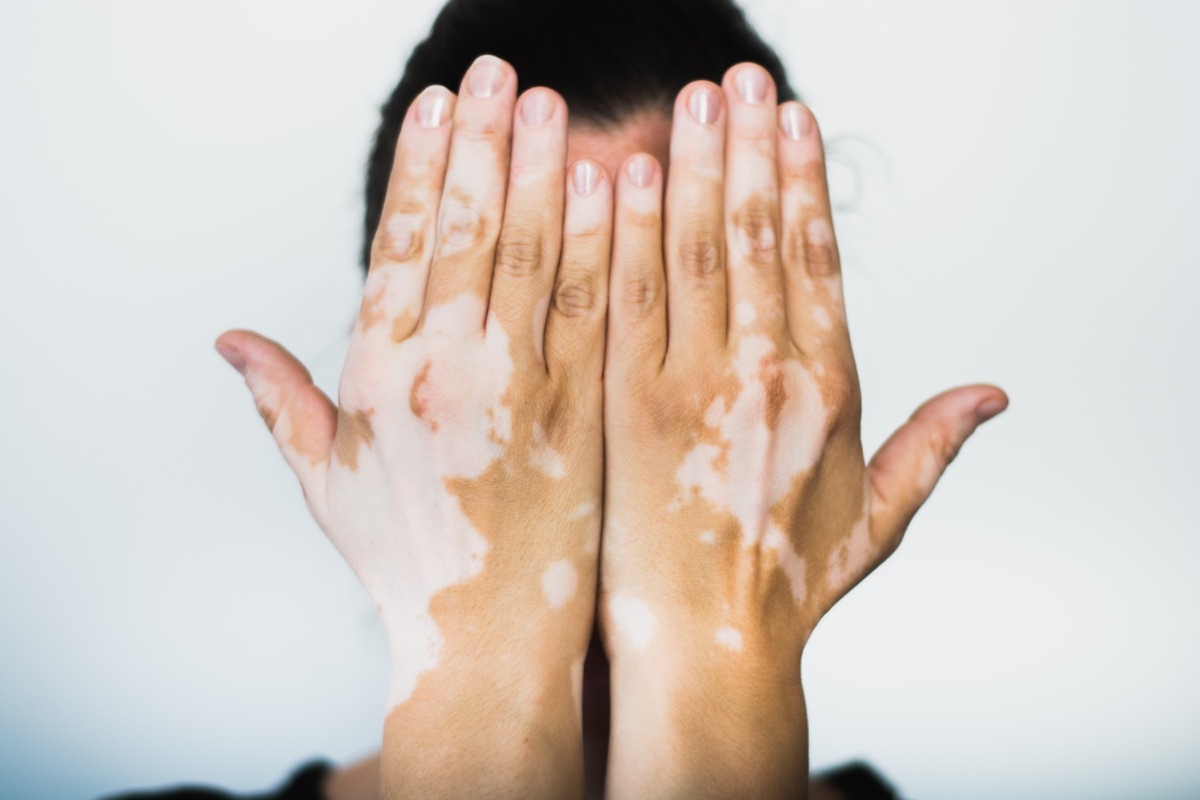 vitiligo