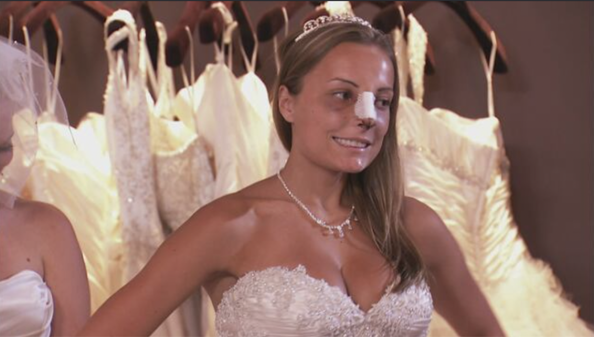 A contestant on the reality show, Bridal Plasty in a wedding dress with a cast on her nose.