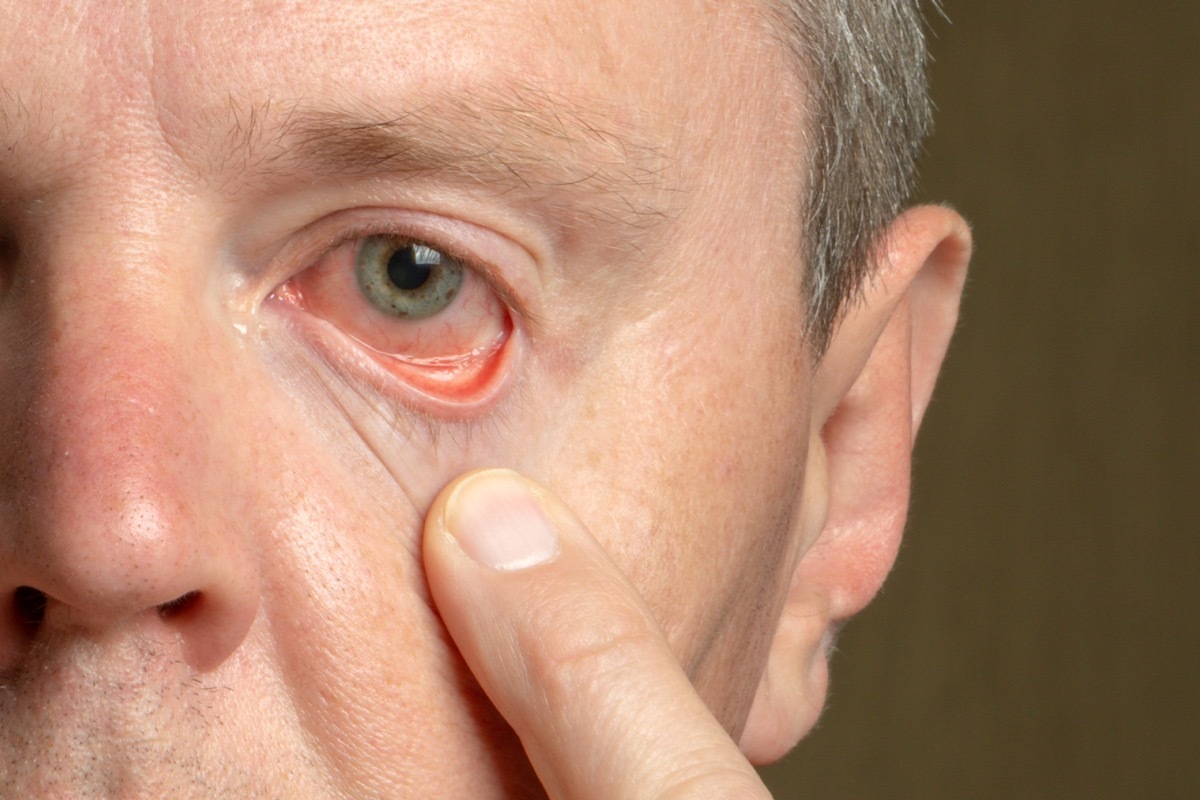 Older man with watery eyes signs of poor health over 50