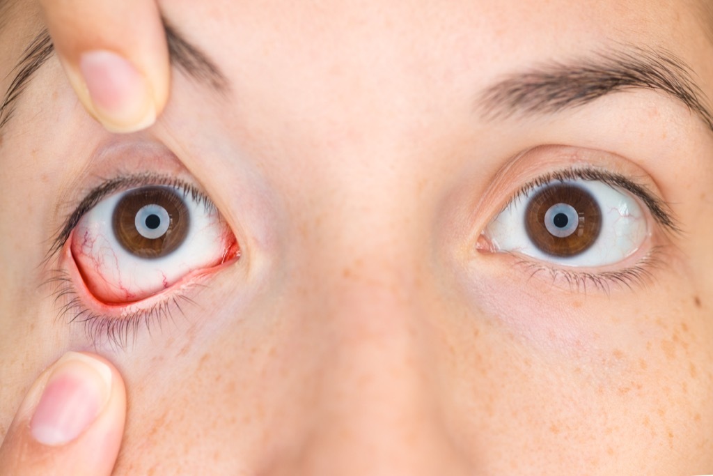 Woman's eyes are inflamed, infection, cornea