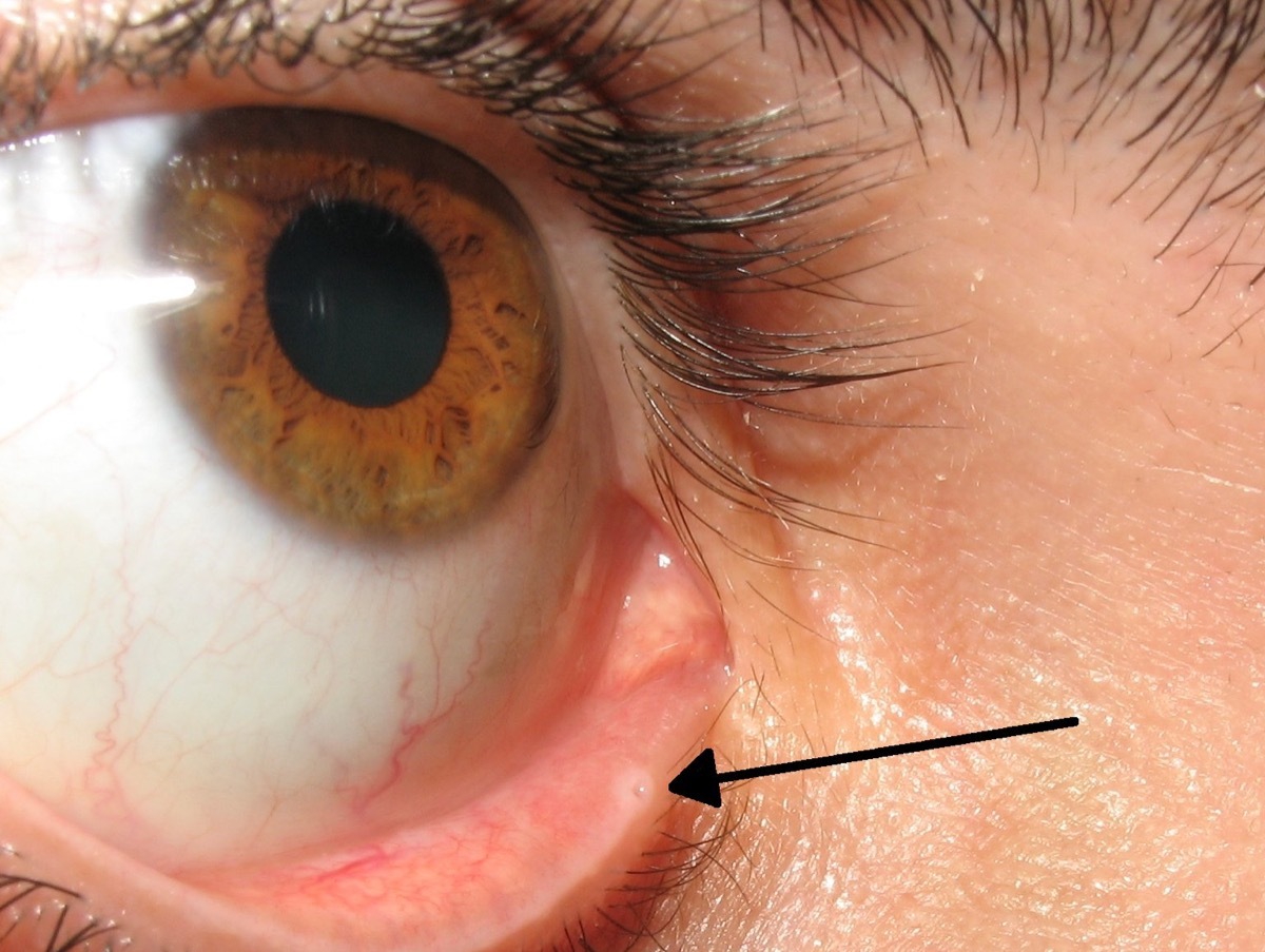 lacrimal punctum 