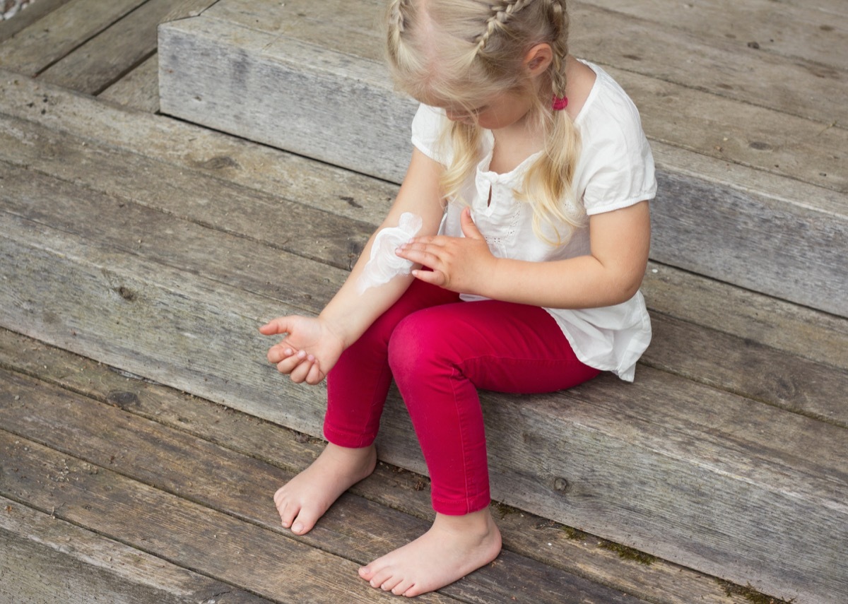 Little girl with cream on her arm for her eczema allergic reaction